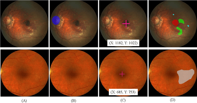 Figure 3 for ADAM Challenge: Detecting Age-related Macular Degeneration from Fundus Images