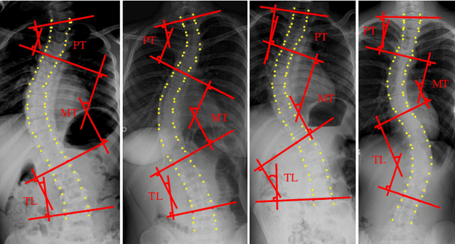 Figure 1 for Vertebra-Focused Landmark Detection for Scoliosis Assessment