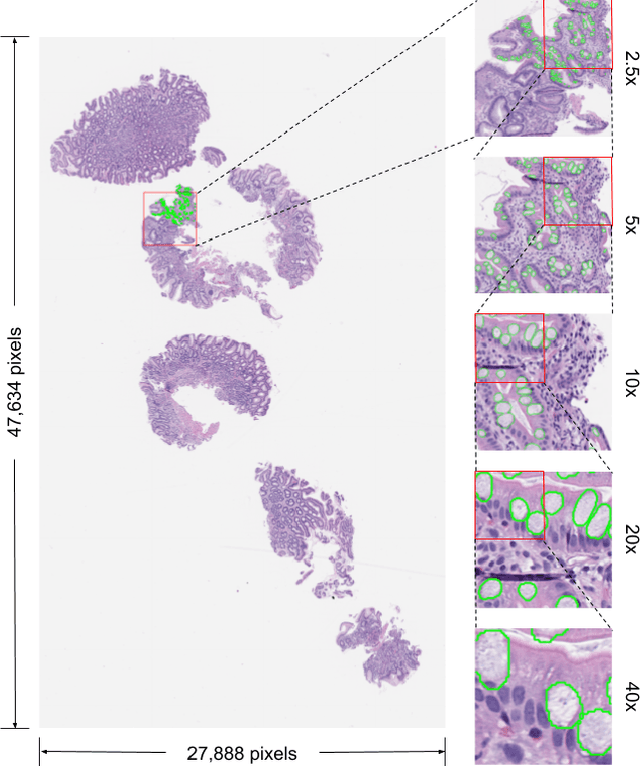 Figure 1 for Deep Learning-Based Sparse Whole-Slide Image Analysis for the Diagnosis of Gastric Intestinal Metaplasia