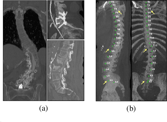 Figure 1 for Adversarially Learning a Local Anatomical Prior: Vertebrae Labelling with 2D reformations