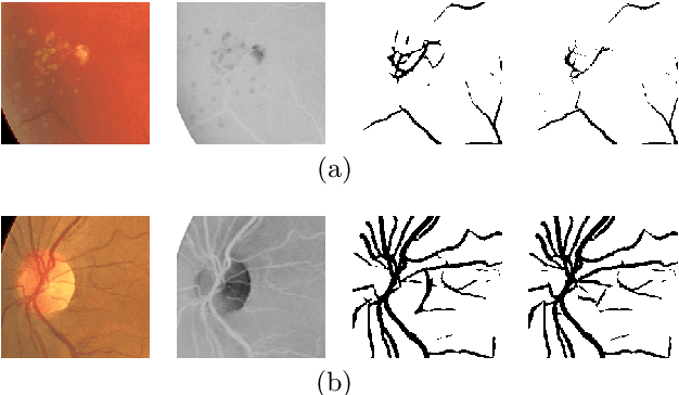 Figure 4 for Application of Top-hat Transformation for Enhanced Blood Vessel Extraction