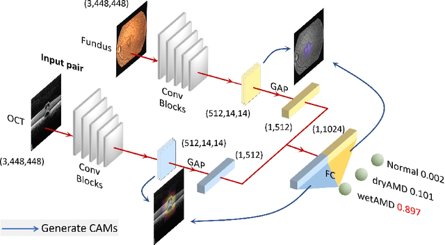 Figure 1 for Two-Stream CNN with Loose Pair Training for Multi-modal AMD Categorization