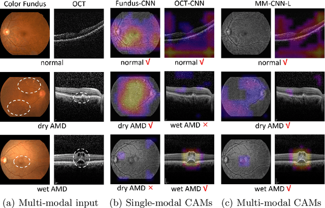 Figure 3 for Two-Stream CNN with Loose Pair Training for Multi-modal AMD Categorization