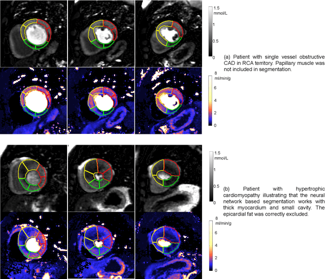 Figure 4 for Automated Inline Analysis of Myocardial Perfusion MRI with Deep Learning