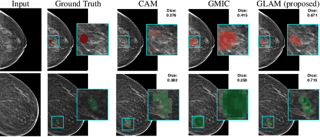 Figure 1 for Weakly-supervised High-resolution Segmentation of Mammography Images for Breast Cancer Diagnosis