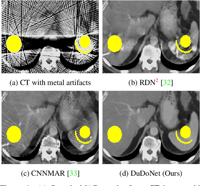 Figure 1 for DuDoNet: Dual Domain Network for CT Metal Artifact Reduction