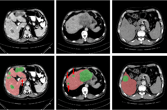 Figure 1 for Decoupled Pyramid Correlation Network for Liver Tumor Segmentation from CT images
