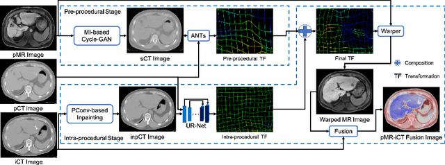 Figure 1 for Synthesis and Inpainting-Based MR-CT Registration for Image-Guided Thermal Ablation of Liver Tumors