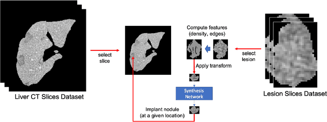 Figure 3 for Implanting Synthetic Lesions for Improving Liver Lesion Segmentation in CT Exams
