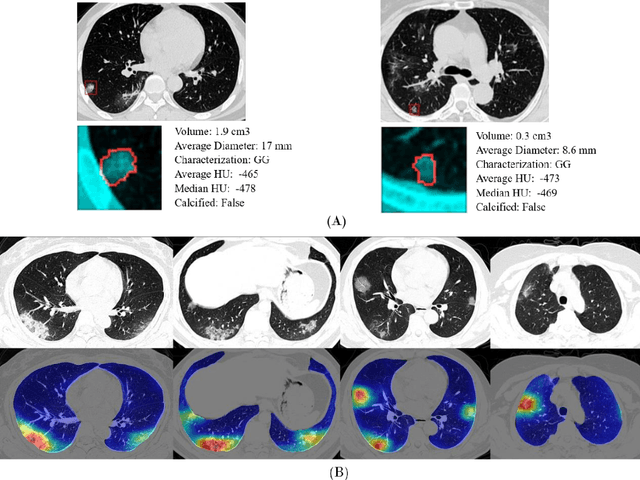 Figure 2 for Rapid AI Development Cycle for the Coronavirus (COVID-19) Pandemic: Initial Results for Automated Detection & Patient Monitoring using Deep Learning CT Image Analysis