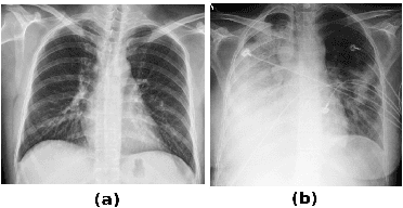 Figure 1 for Lung Segmentation from Chest X-rays using Variational Data Imputation