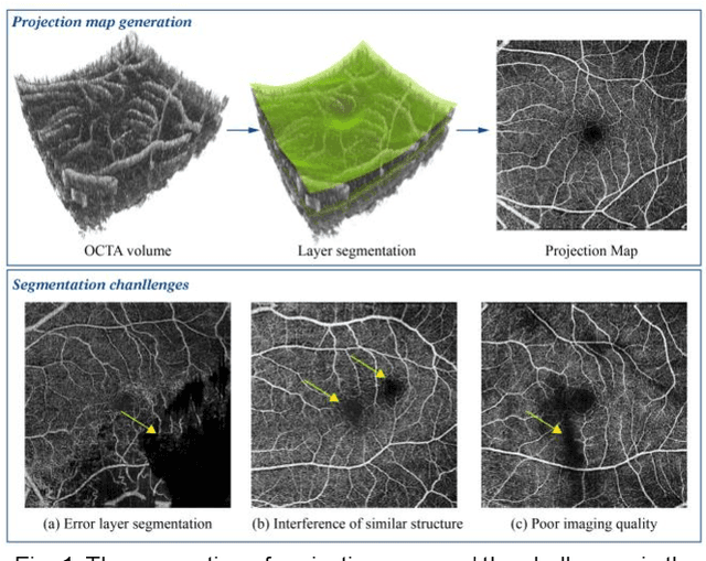 Figure 1 for IPN-V2 and OCTA-500: Methodology and Dataset for Retinal Image Segmentation
