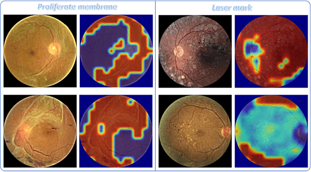 Figure 4 for DR-GAN: Conditional Generative Adversarial Network for Fine-Grained Lesion Synthesis on Diabetic Retinopathy Images