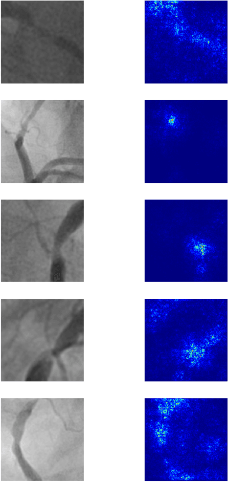 Figure 4 for CathAI: Fully Automated Interpretation of Coronary Angiograms Using Neural Networks