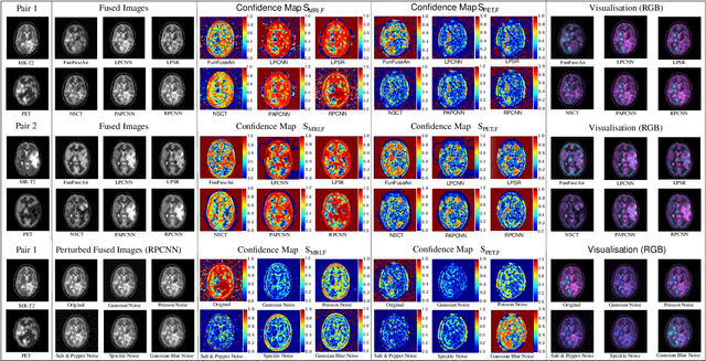 Figure 2 for Visualisation of Medical Image Fusion and Translation for Accurate Diagnosis of High Grade Gliomas