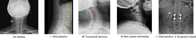 Figure 4 for VinDr-SpineXR: A deep learning framework for spinal lesions detection and classification from radiographs