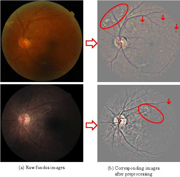 Figure 4 for Lesion detection and Grading of Diabetic Retinopathy via Two-stages Deep Convolutional Neural Networks