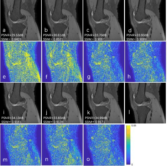 Figure 4 for Denoising of Three-Dimensional Fast Spin Echo Magnetic Resonance Images of Knee Joints using Spatial-Variant Noise-Relevant Residual Learning of Convolution Neural Network