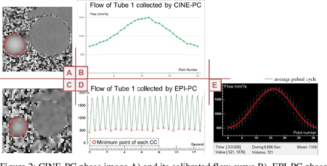 Figure 2 for Accuracy of Real-Time Echo-Planar Imaging Phase Contrast MRI