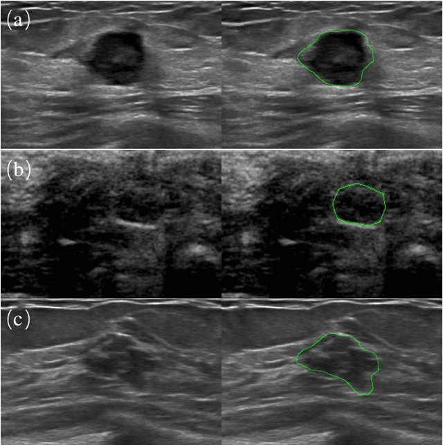 Figure 1 for Global Guidance Network for Breast Lesion Segmentation in Ultrasound Images