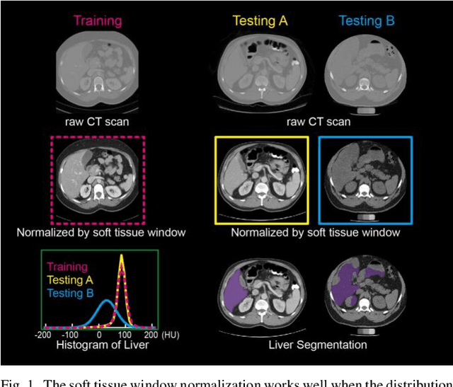 Figure 1 for Stochastic tissue window normalization of deep learning on computed tomography