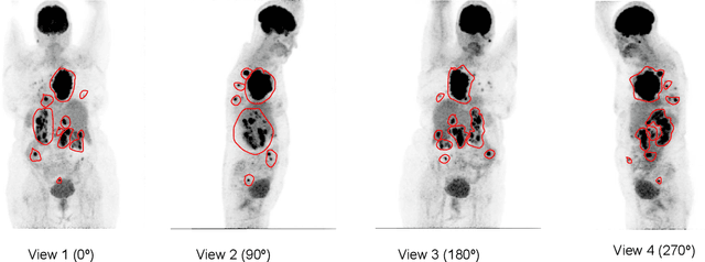Figure 1 for Lymphoma segmentation from 3D PET-CT images using a deep evidential network