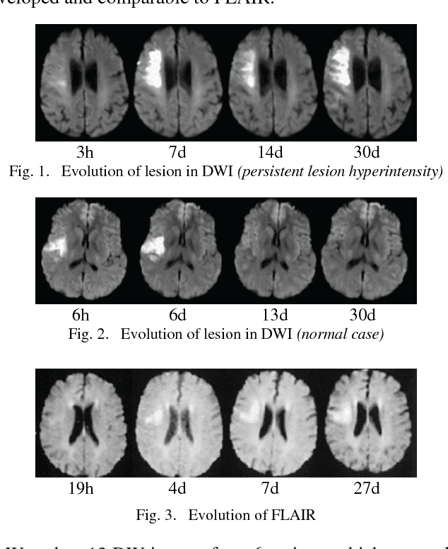 Figure 1 for Automatic Stroke Lesions Segmentation in Diffusion-Weighted MRI