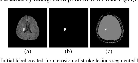 Figure 2 for Automatic Stroke Lesions Segmentation in Diffusion-Weighted MRI