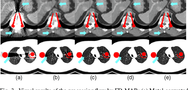 Figure 3 for FD-MAR: Fourier Dual-domain Network for CT Metal Artifact Reduction