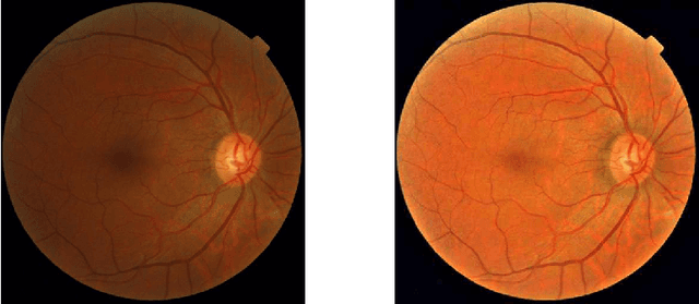 Figure 1 for Learned Pre-Processing for Automatic Diabetic Retinopathy Detection on Eye Fundus Images
