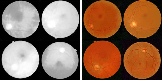 Figure 4 for Learned Pre-Processing for Automatic Diabetic Retinopathy Detection on Eye Fundus Images