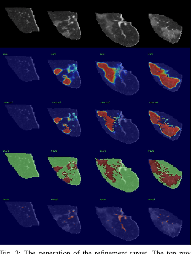 Figure 3 for Dense Regression Activation Maps For Lesion Segmentation in CT scans of COVID-19 patients
