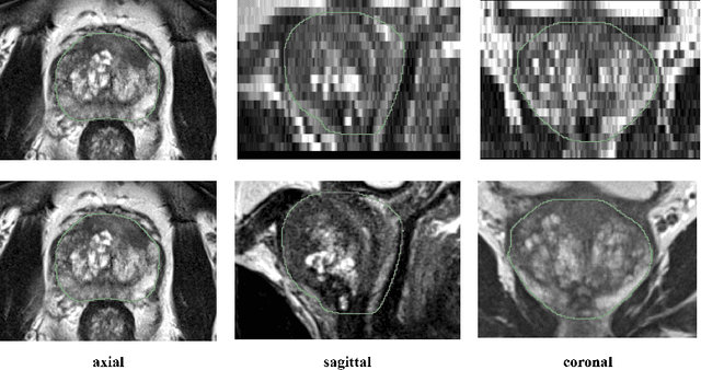 Figure 1 for Anisotropic 3D Multi-Stream CNN for Accurate Prostate Segmentation from Multi-Planar MRI