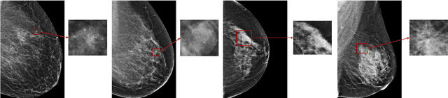 Figure 1 for An interpretable classifier for high-resolution breast cancer screening images utilizing weakly supervised localization
