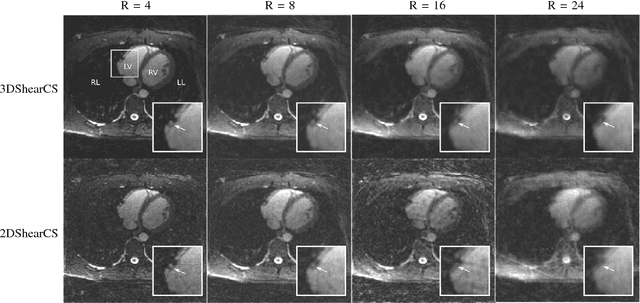 Figure 1 for Shearlet-based compressed sensing for fast 3D cardiac MR imaging using iterative reweighting