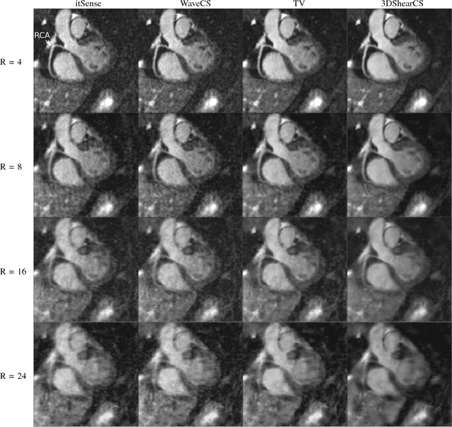 Figure 4 for Shearlet-based compressed sensing for fast 3D cardiac MR imaging using iterative reweighting