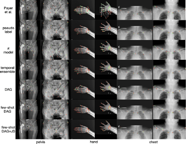 Figure 4 for Scalable Semi-supervised Landmark Localization for X-ray Images using Few-shot Deep Adaptive Graph