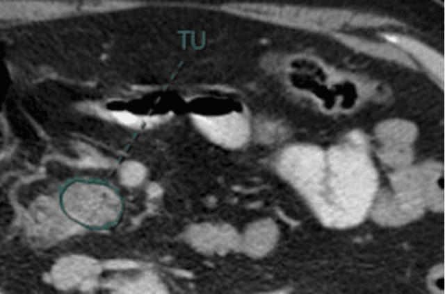 Figure 3 for Improving Prognostic Value of CT Deep Radiomic Features in Pancreatic Ductal Adenocarcinoma Using Transfer Learning