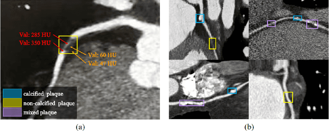 Figure 1 for Transformer Network for Significant Stenosis Detection in CCTA of Coronary Arteries