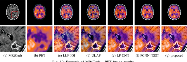 Figure 2 for Coupled Feature Learning for Multimodal Medical Image Fusion