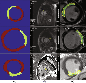 Figure 3 for Direct detection of pixel-level myocardial infarction areas via a deep-learning algorithm
