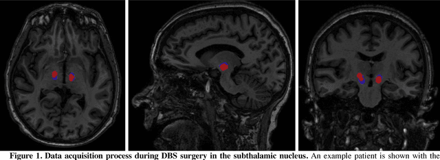Figure 1 for Towards Machine Learning Prediction of Deep Brain Stimulation (DBS) Intra-operative Efficacy Maps