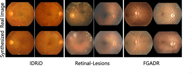 Figure 2 for Explainable Diabetic Retinopathy Detection and Retinal Image Generation