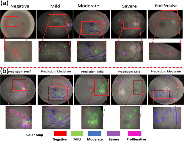Figure 4 for Discovery Radiomics with CLEAR-DR: Interpretable Computer Aided Diagnosis of Diabetic Retinopathy