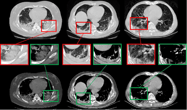 Figure 1 for COVID-19 Chest CT Image Segmentation -- A Deep Convolutional Neural Network Solution