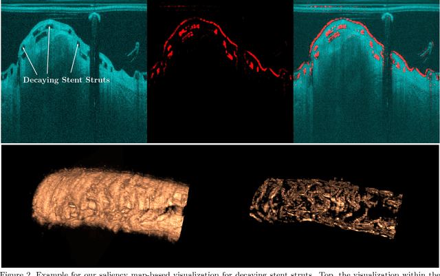 Figure 2 for Bioresorbable Scaffold Visualization in IVOCT Images Using CNNs and Weakly Supervised Localization