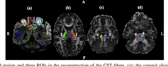 Figure 2 for Corticospinal Tract (CST) reconstruction based on fiber orientation distributions(FODs) tractography