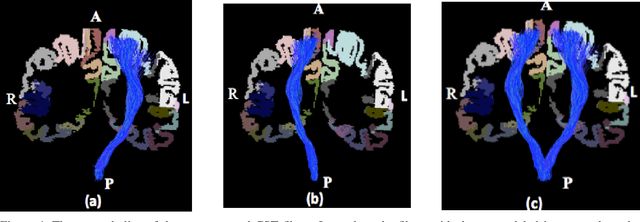 Figure 4 for Corticospinal Tract (CST) reconstruction based on fiber orientation distributions(FODs) tractography