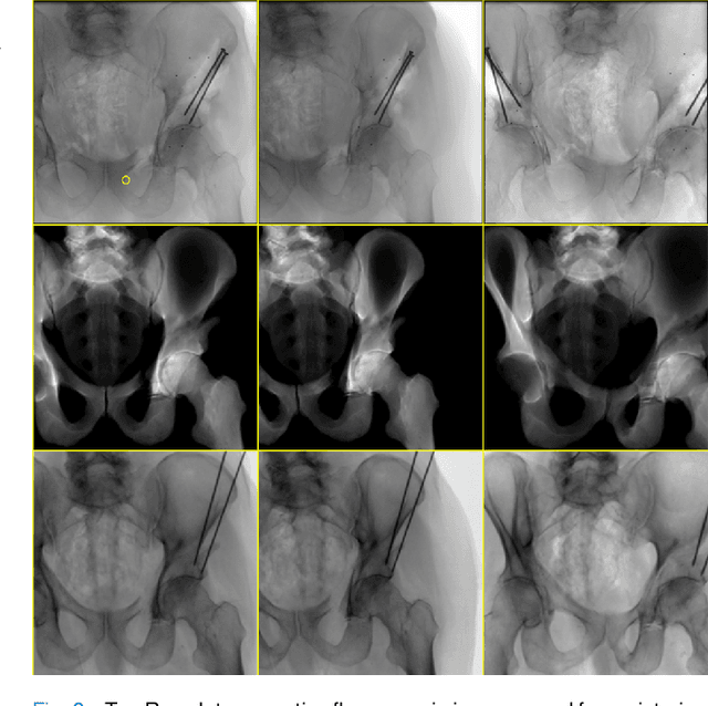 Figure 3 for Pose Estimation of Periacetabular Osteotomy Fragments with Intraoperative X-Ray Navigation