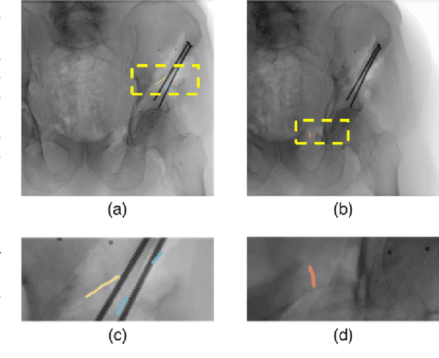 Figure 4 for Pose Estimation of Periacetabular Osteotomy Fragments with Intraoperative X-Ray Navigation